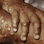 POX
