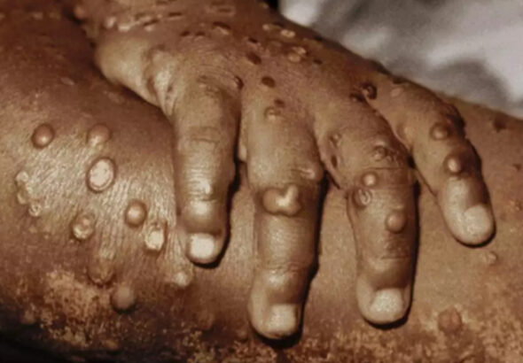 POX