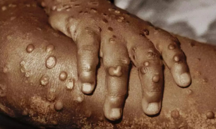POX